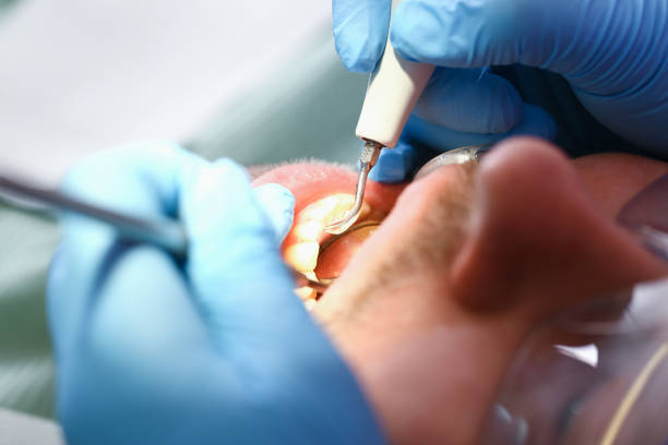 Best Urgent Care for Lost Fillings or Crowns in East Riverdale, MD